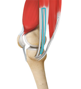 ACL Reconstruction Hamstring Tendon