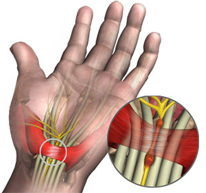 Carpal Tunnel Syndrome