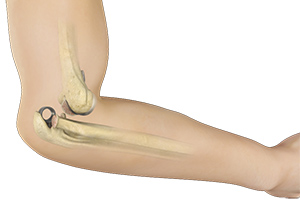 Elbow Dislocations