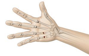 Hand Fractures