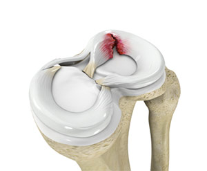 Meniscal Repair