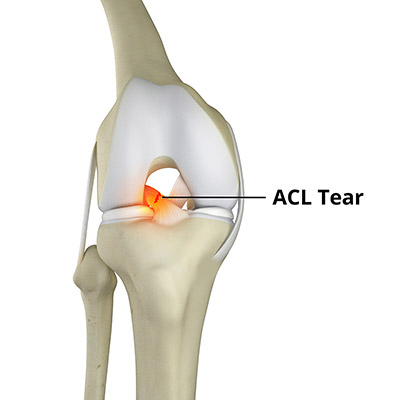 ACL Tears