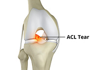 Anterior Cruciate Ligament Tears