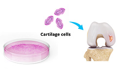 Advantages of Autologous Chondrocyte Implantation