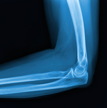 Diagnosis of Elbow Arthritis