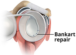 Arthroscopic Bankart Repair Procedure