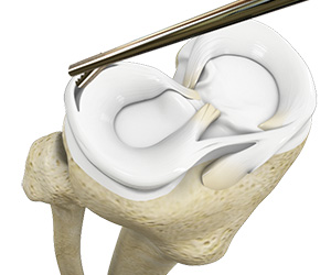 Arthroscopic Meniscectomy