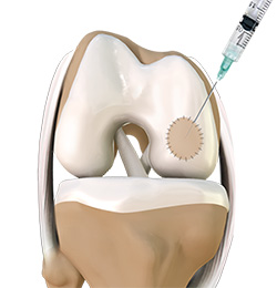 Autologous Chondrocyte Implantation Procedure