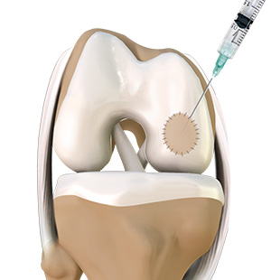 Autologous chondrocyte implantation