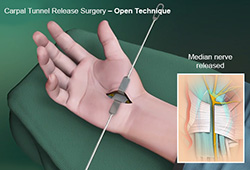 Carpal Tunnel Release Surgery