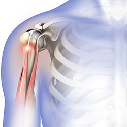 Causes of Biceps Tendon Rupture