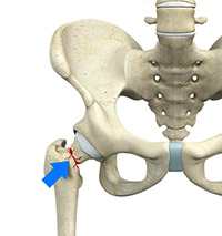 Causes of Hip Fractures