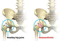 Causes of Hip Pain