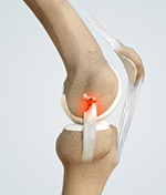 Causes of Knee Injury