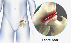 Causes of Labral Tear