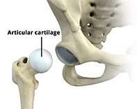 Causes of Osteoarthritis of the Hip