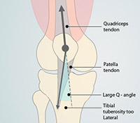 Causes of Patellofemoral Instability