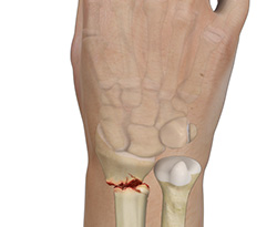 Causes of Wrist Fractures