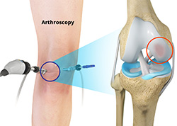 Chondroplasty Procedure