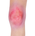 Common Symptoms of a Knee Injury