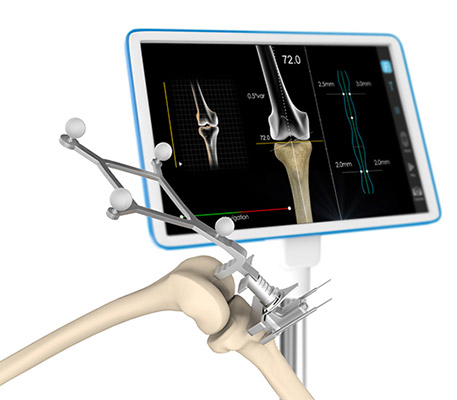 Computer Guided Total Knee Replacement