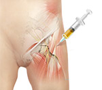 Corticosteroid Injection