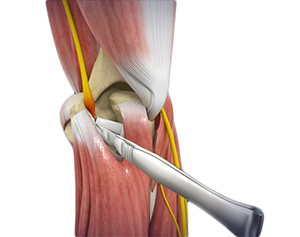 Surgery for Cubital Tunnel Syndrome