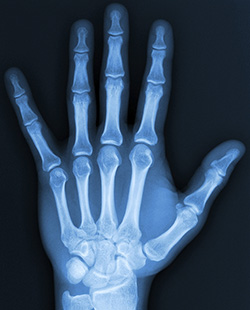 Diagnosing Wrist Fractures
