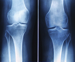 Diagnosis of Arthritis