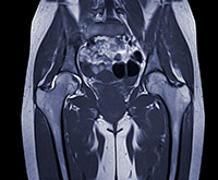 Diagnosis of a Hip Labral Tear