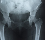 Diagnosis of an Irritable Hip