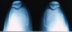 Diagnosis of Anterior Knee Pain