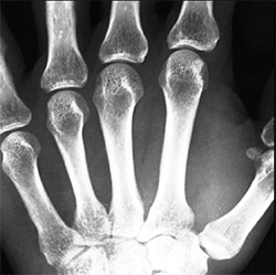 Diagnosis of Arthritis of the Thumb