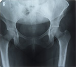 Diagnosis of Hip Dislocation