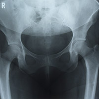 Diagnosis of Hip Fractures