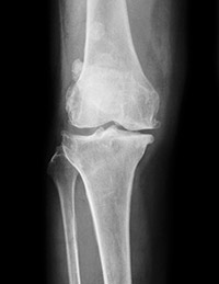Diagnosis of Knee Fracture