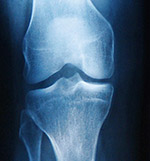 Diagnosis of Knee Injury