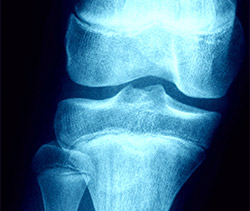 Diagnosis of Osgood-Schlatter Disease