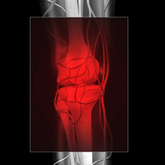 Diagnosis of Osteochondritis Dissecans