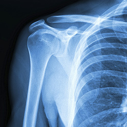 Diagnosis of Shoulder Arthritis