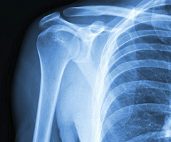 Diagnosis of Shoulder Fracture