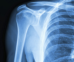 Diagnosis of Shoulder Impingement