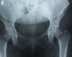 Diagnosis of Slipped Capital Femoral Epiphysis