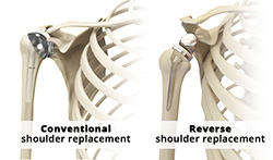 Differences between Conventional and Reverse Shoulder Replacement