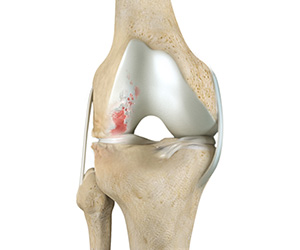 Disease Overview of Arthritis