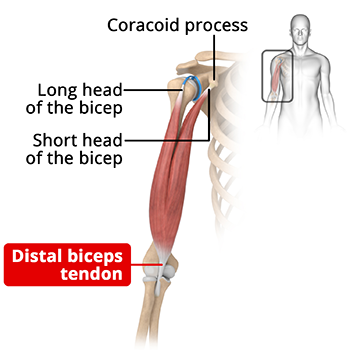 What is Distal Biceps Avulsion