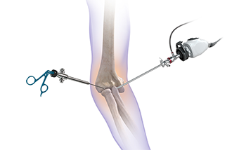 What is Elbow Arthroscopy