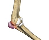 What is Elbow Bursitis