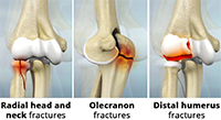 What is Elbow Fracture Reconstruction