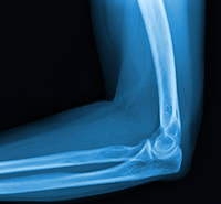 What is Elbow Fracture Reconstruction